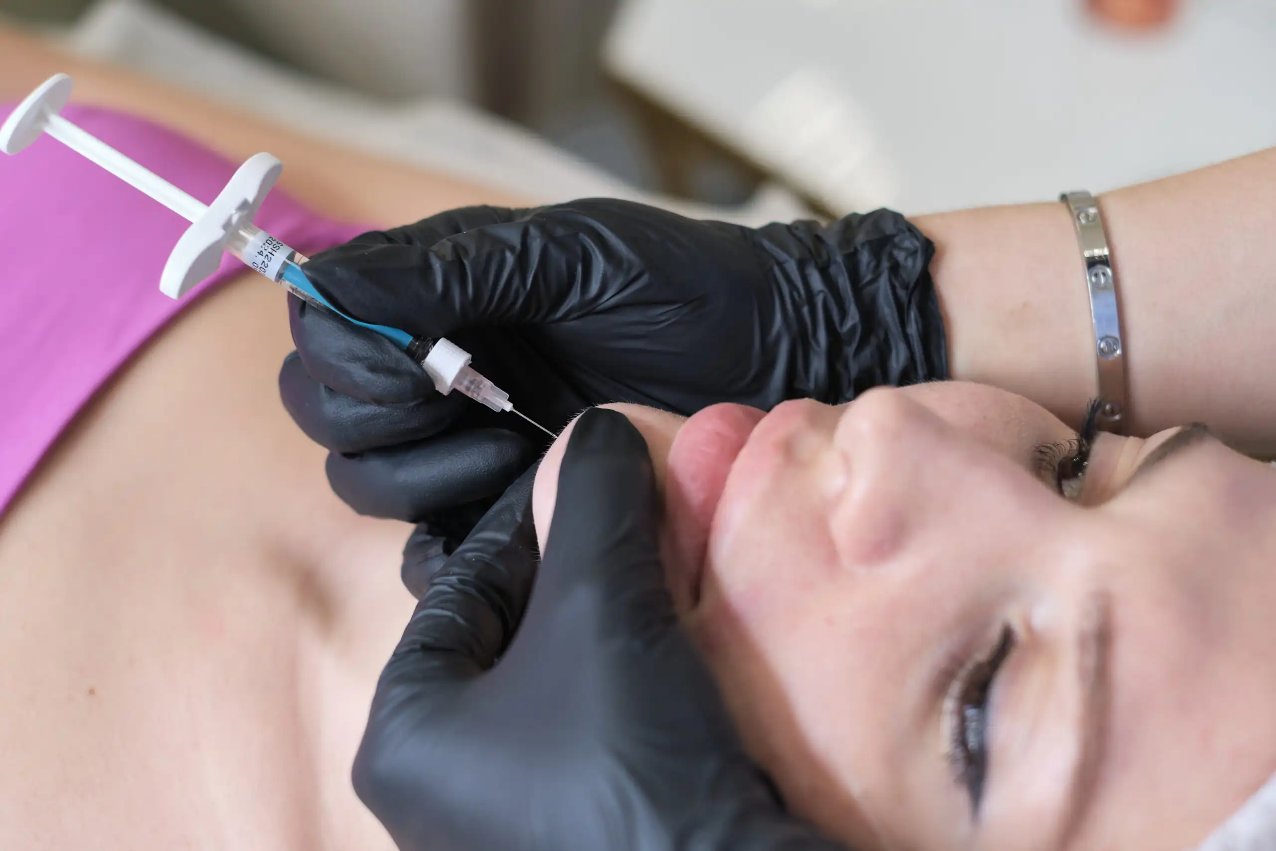 Dermal Filler Injection Procedure